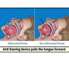 Anti Snoring Mouthpiece Tongue Retainer Helps to Eliminate Snoring Anti Snore Device Silicone Snore Sleep Apnea Anti Ronflement